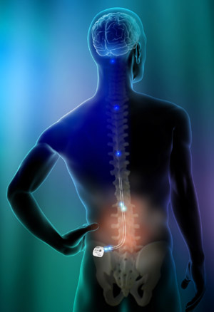 Oracle Pain Clinic Spinal Cord Stimulation Oracle Pain Clinic Spinal Cord Stimulation